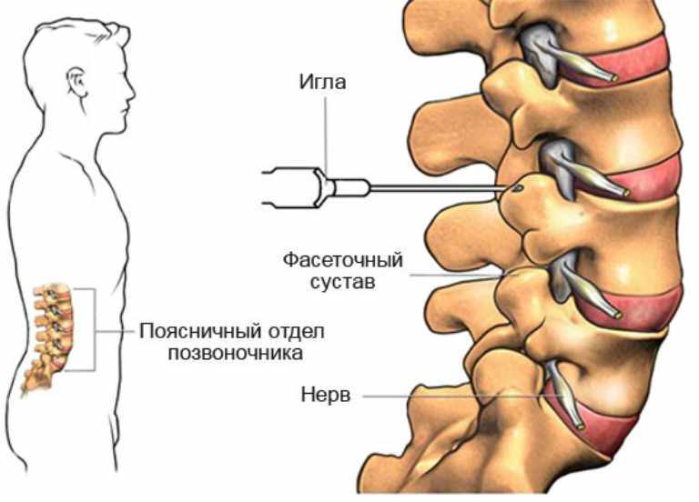 линками желаете? уколы в шею при остеохондрозе отзывы ваша
